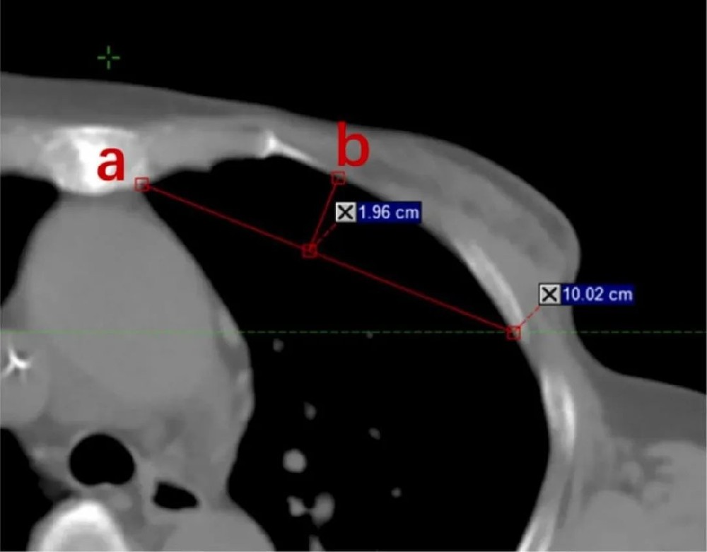 图1:弧高与基底比(AHBR)的测量示意图
