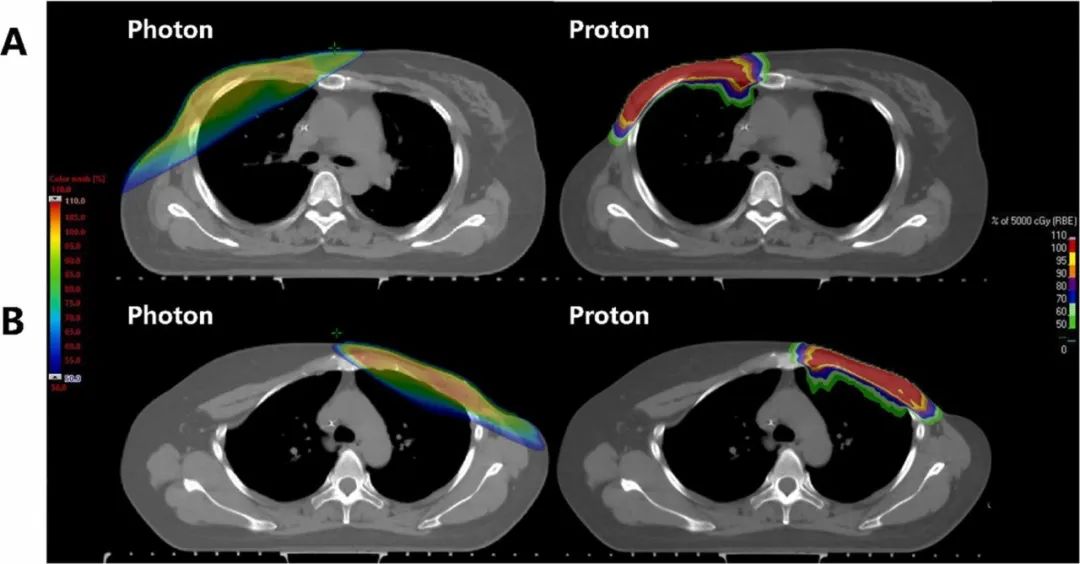 图3:胸骨角平面质子与光子计划的 50% 等剂量线对比