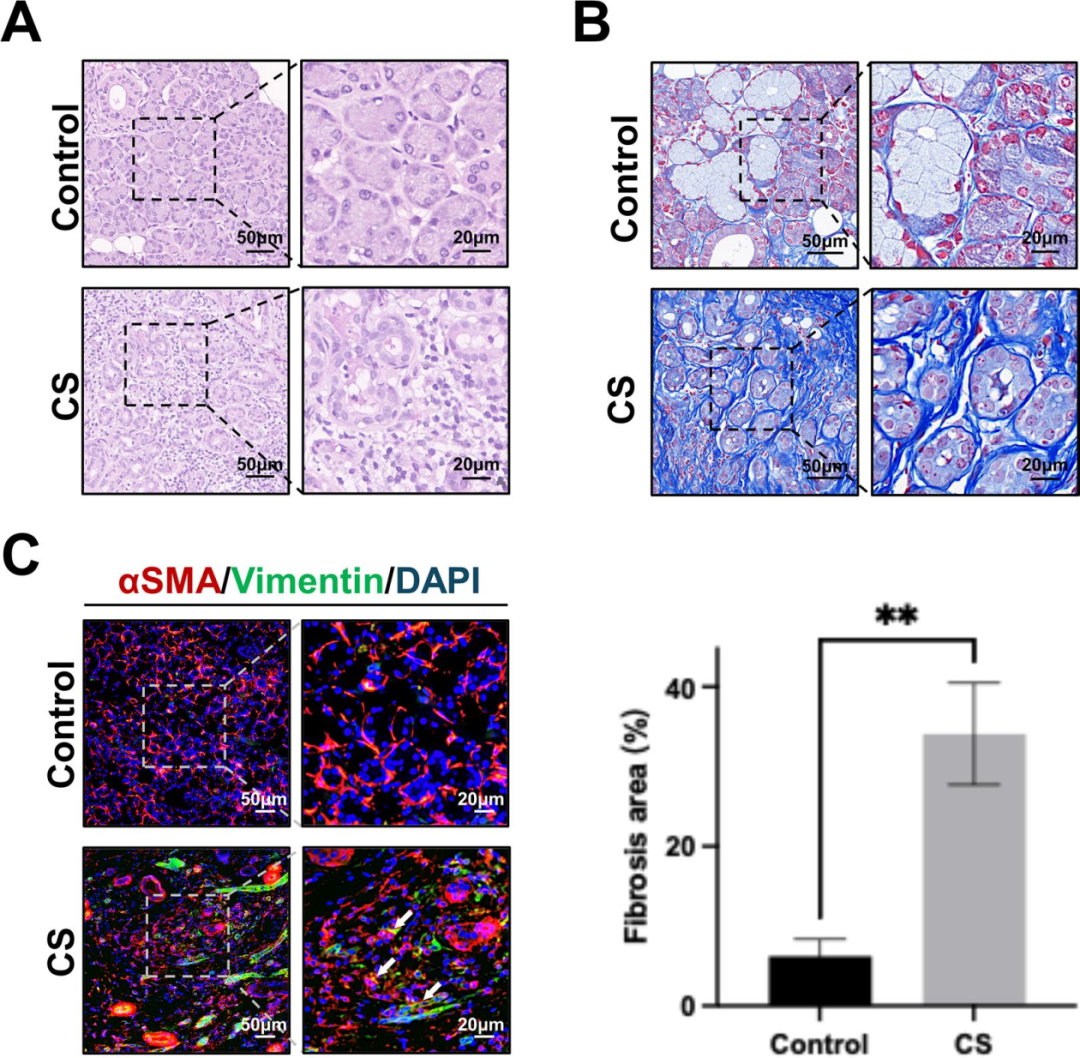 图1展示了正常和慢性腮腺炎(CS)组织的组织学变化。