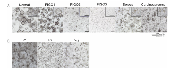 图 2 源自正常子宫内膜和癌组织的患者源性类器官