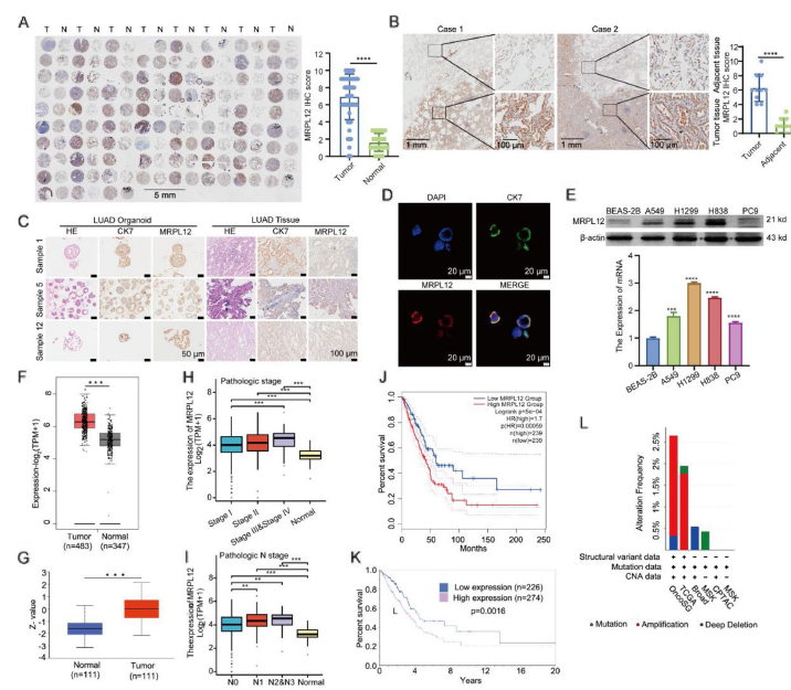 图 3 MRPL12 在肺腺癌类器官、组织和细胞中过表达，且与不良生存相关
