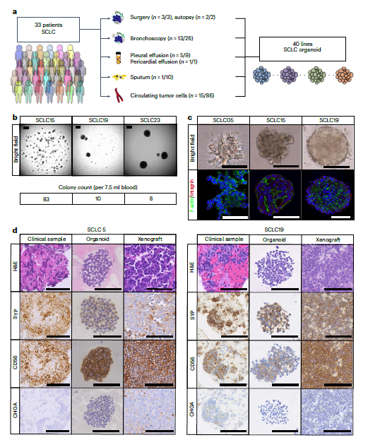 图 1 人源小细胞肺癌类器官库的建立
