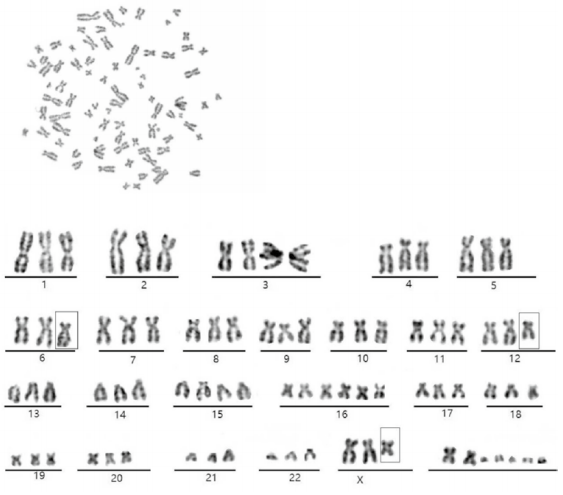 ICC-X3人肝内胆管癌细胞核型分析图