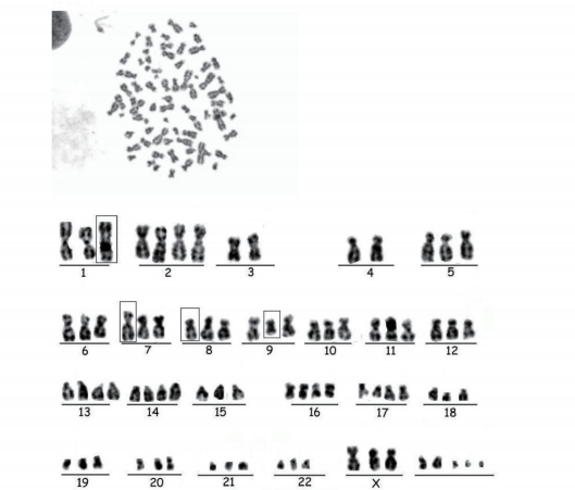 ICC-X2人肝内胆管癌细胞核型分析图