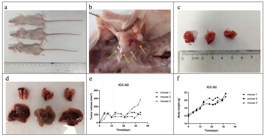 ICC-X2人肝内胆管癌细胞异植瘤形成实验研究图