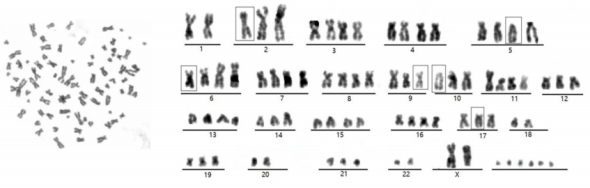 DPC-X1人混合型壶腹癌细胞核型分析图