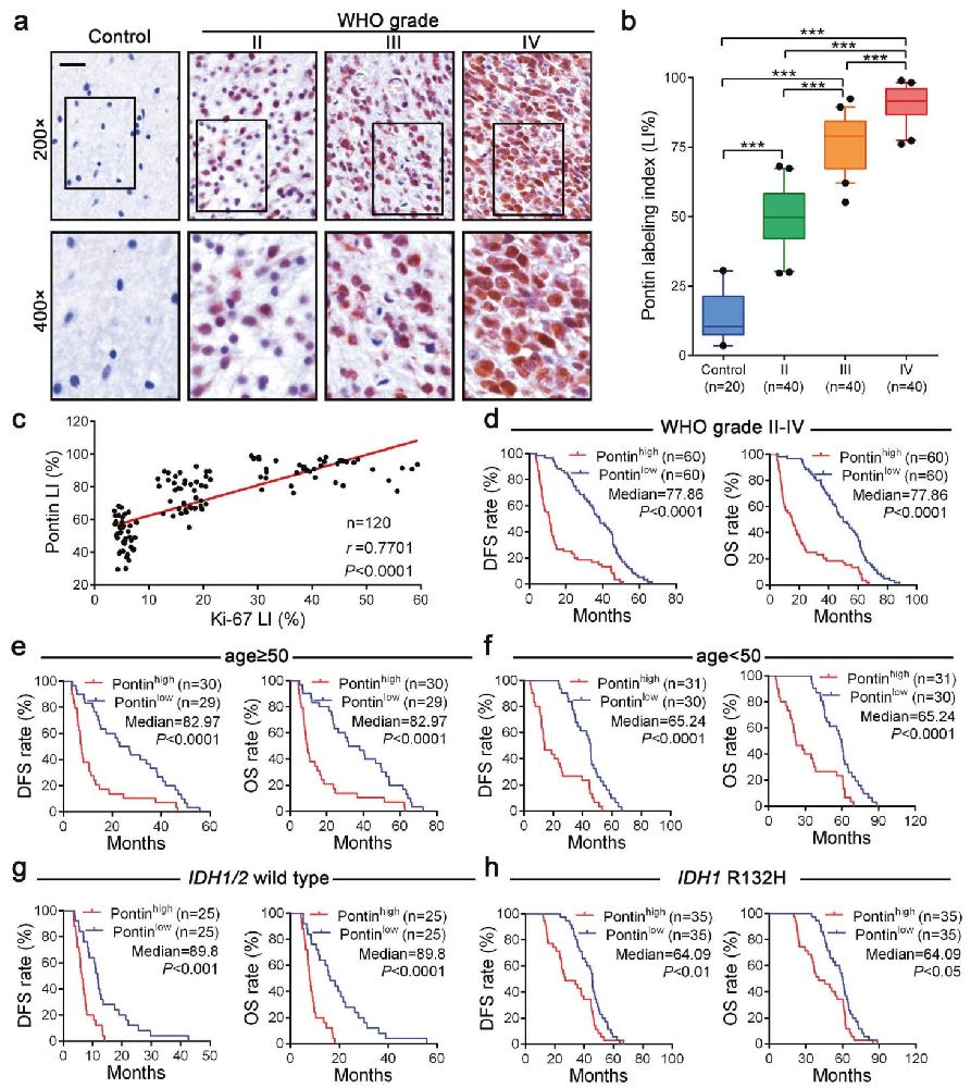 图1：Pontin 过表达与胶质瘤分级升高及患者预后不良相关