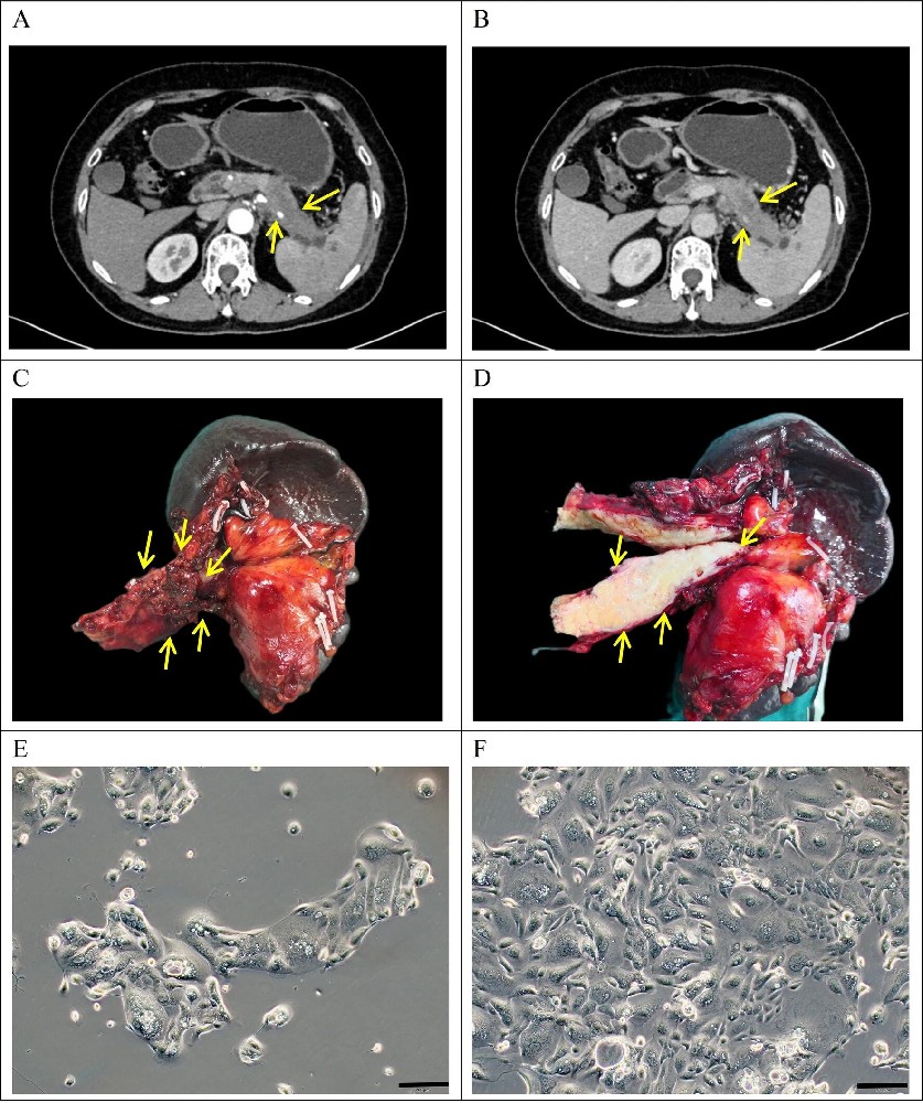 图1：患者临床数据与 PDAC-X2 细胞形态