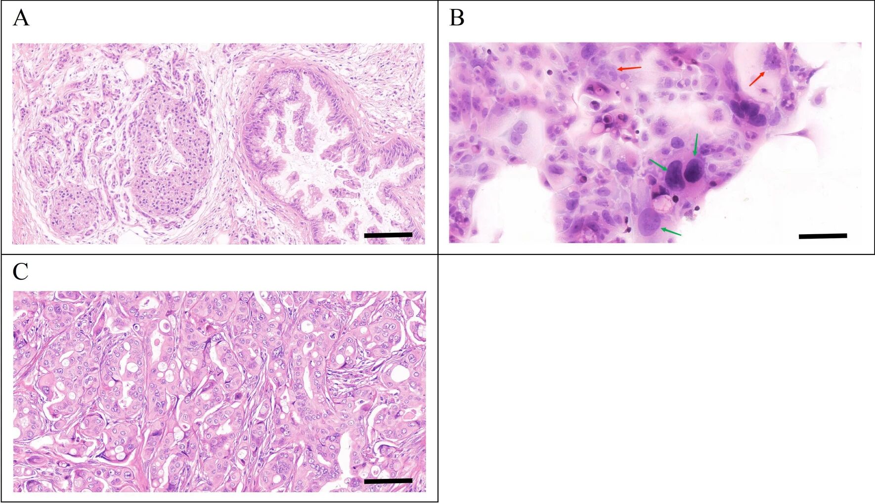 图6：PDAC-X2 及移植瘤的 H&E 染色
