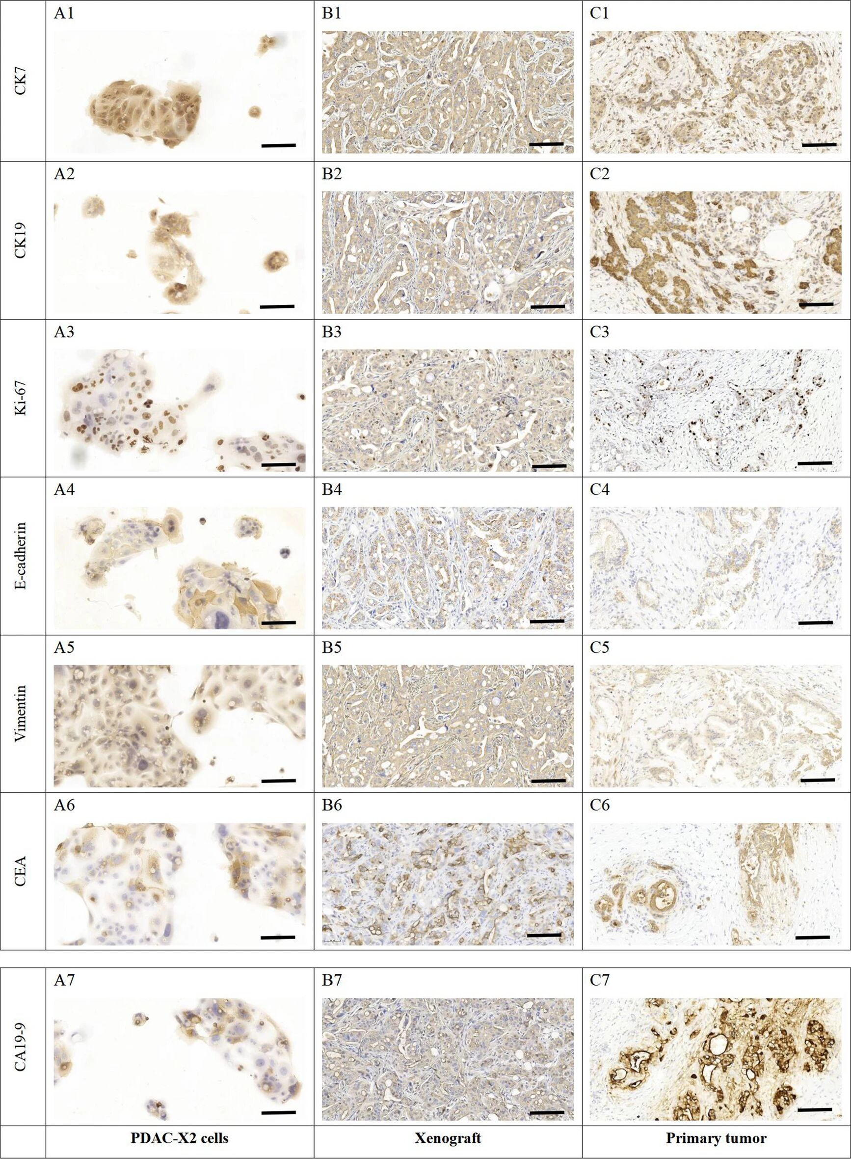 图7：PDAC-X2 的免疫组化特征
