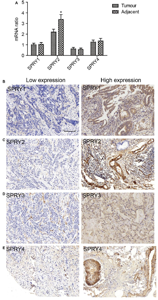 图1：SPRY 家族在 ICC 中的表达特征