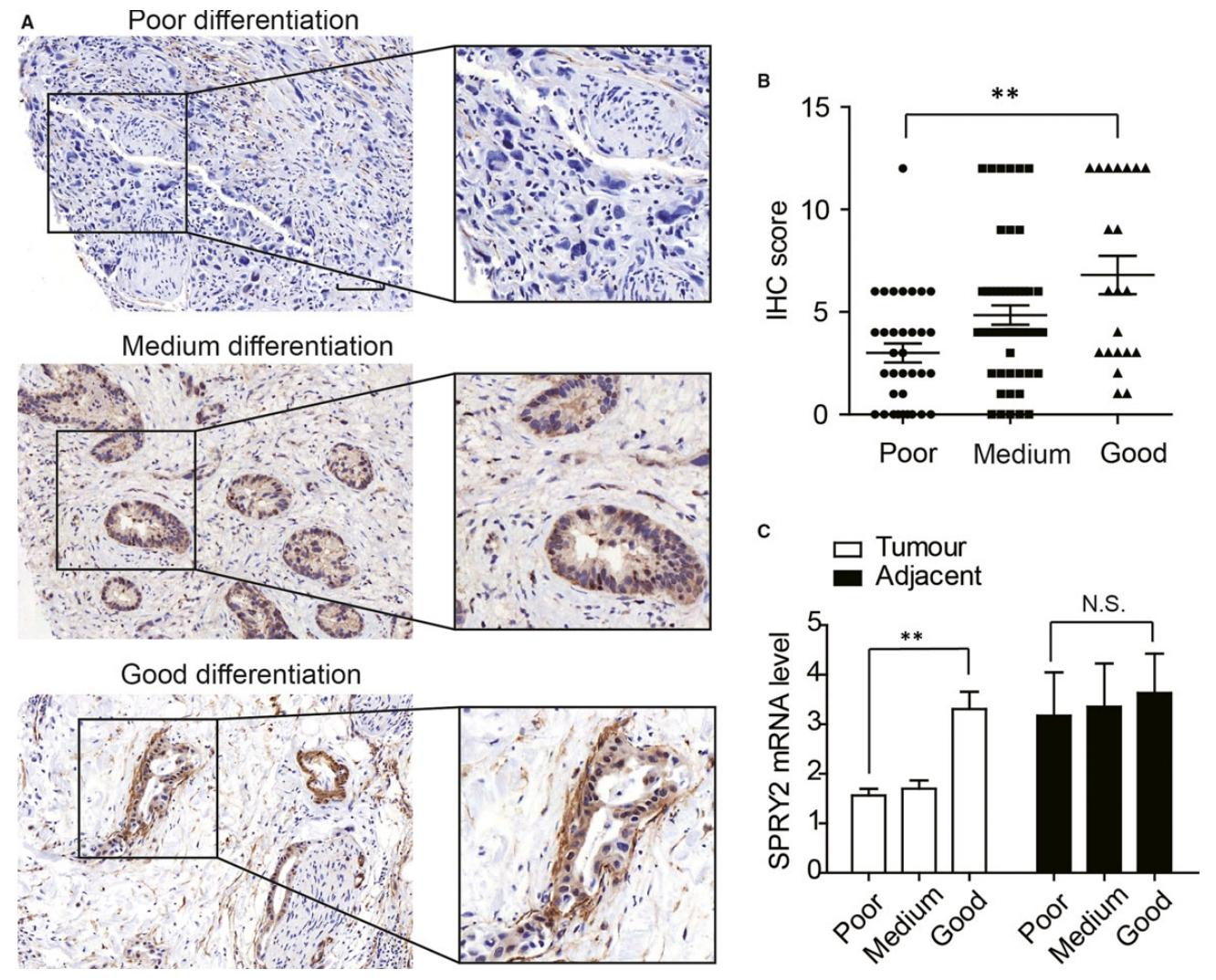 图3：SPRY2 表达与 ICC 分化程度的关联