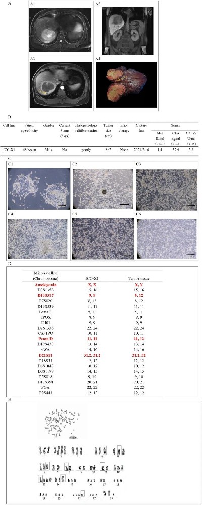 图1：ICC-X1 细胞系的临床背景、形态、STR 检测及核型分析