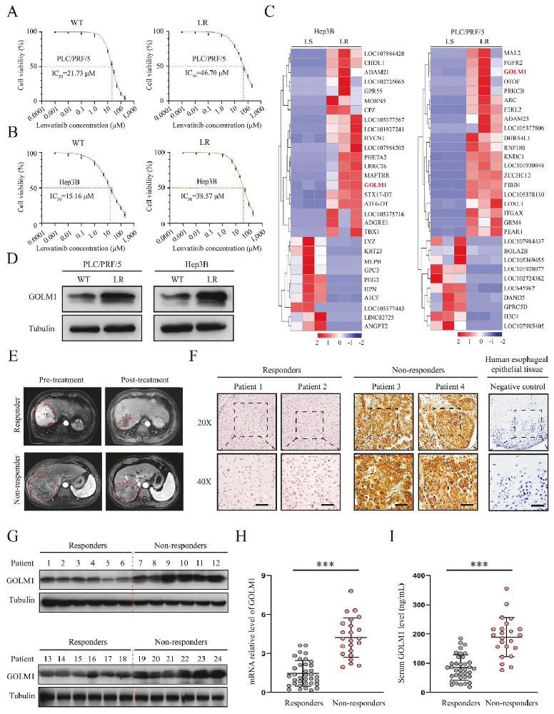 图 1:GOLM1 在乐伐替尼耐药肝癌中高表达