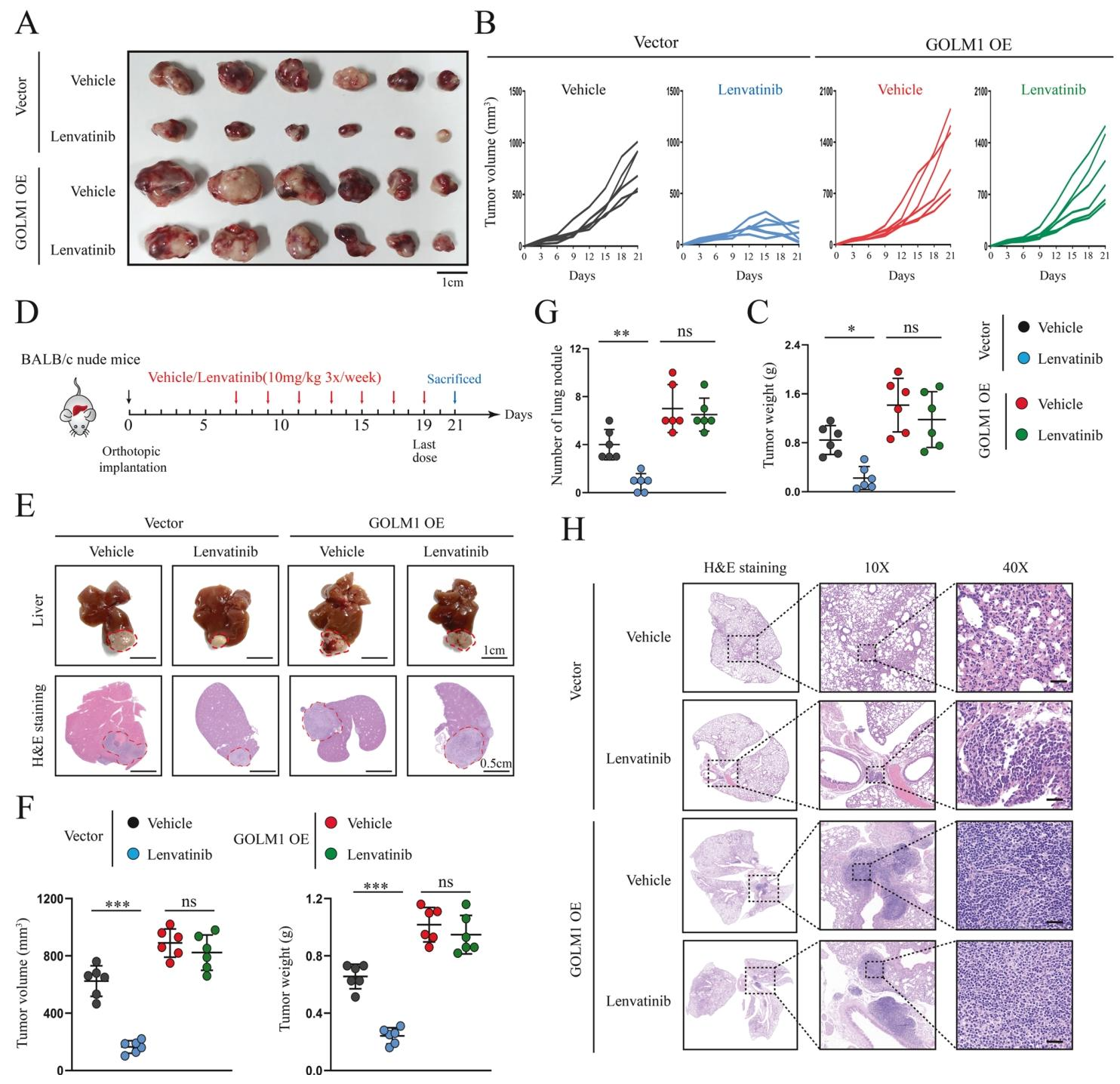 图 3:GOLM1 过表达诱导肝癌体内乐伐替尼耐药