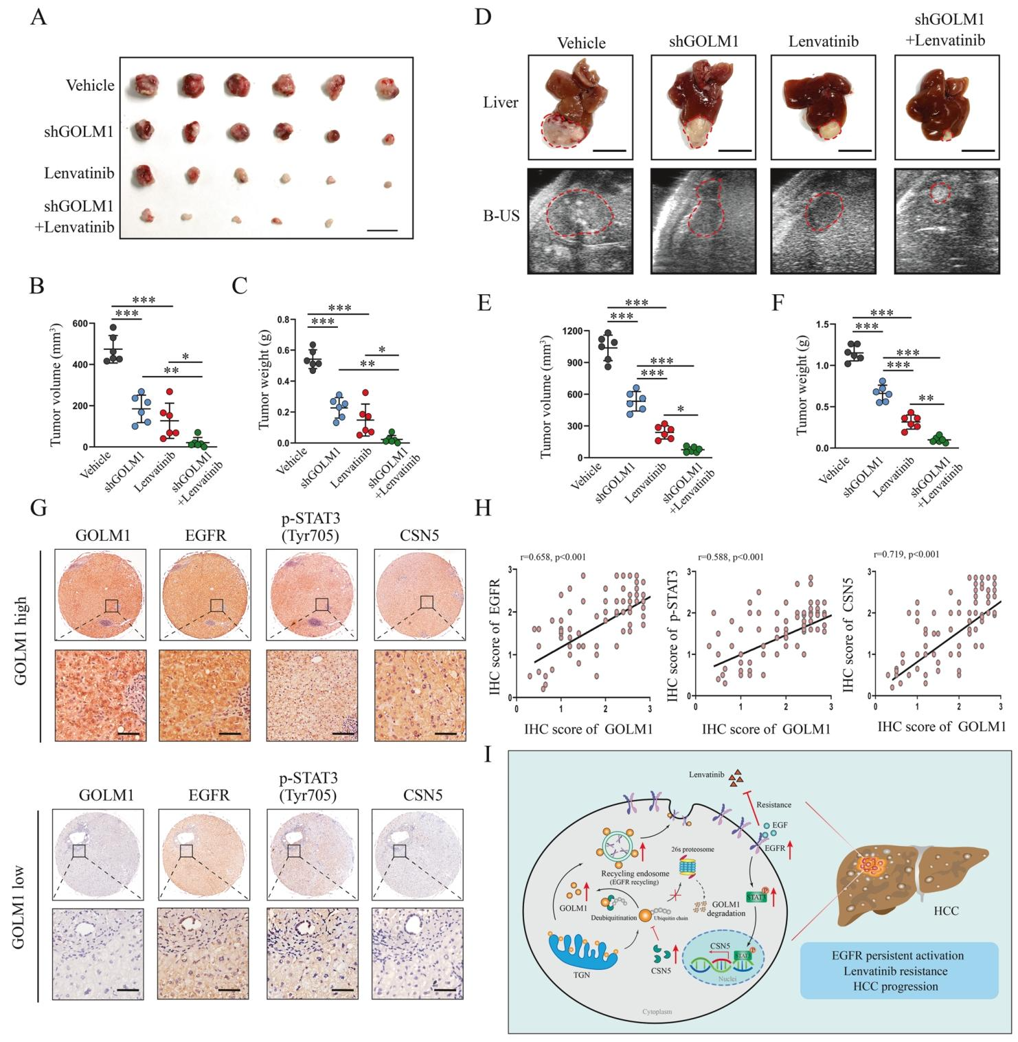 图 7:敲低 GOLM1 与乐伐替尼协同抗肿瘤,GOLM1-EGFR-STAT3-CSN5 通路在临床样本中共激活