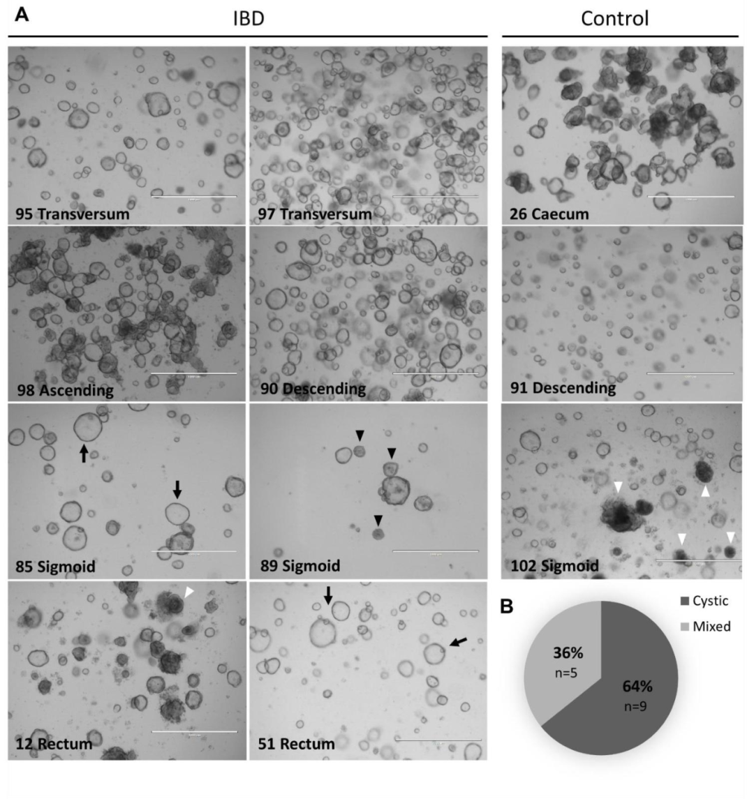 图 2：IBD 与对照类器官的形态差异