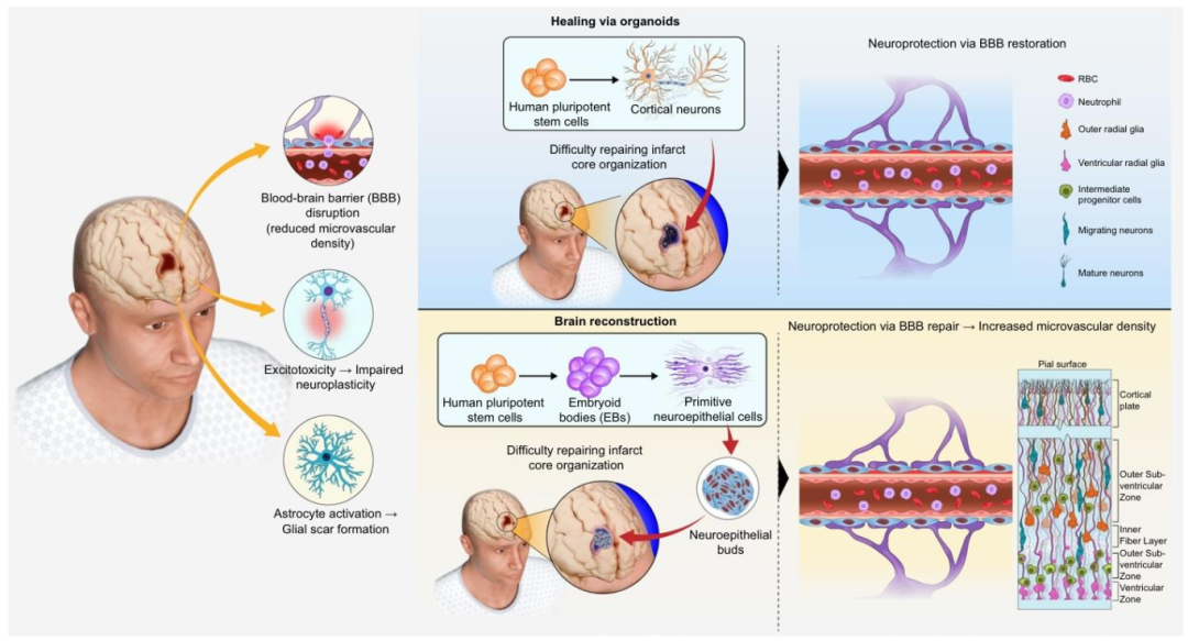 图 3:干细胞移植与类器官移植治疗缺血性中风的对比