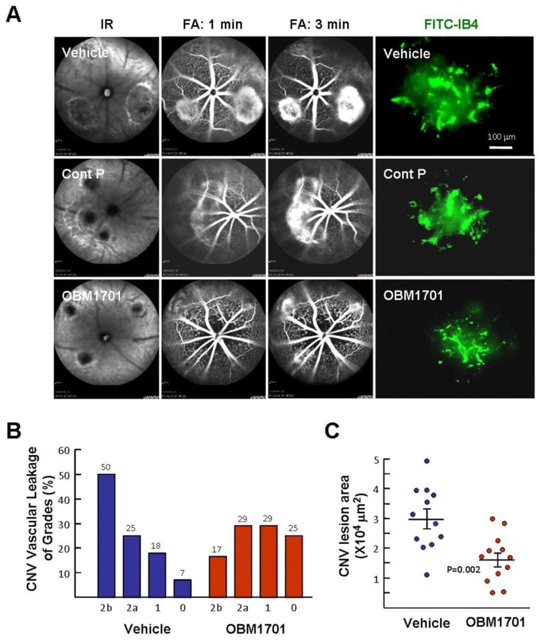 图2：OBM1701 减轻小鼠激光诱导 CNV 的渗漏与面积