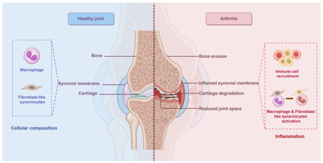 图 1：滑膜的基本结构与 RA 病理变化