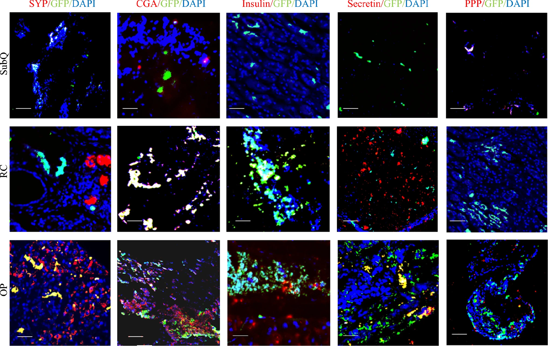 图5：PNET 模型中神经内分泌标志物的共免疫荧光分析