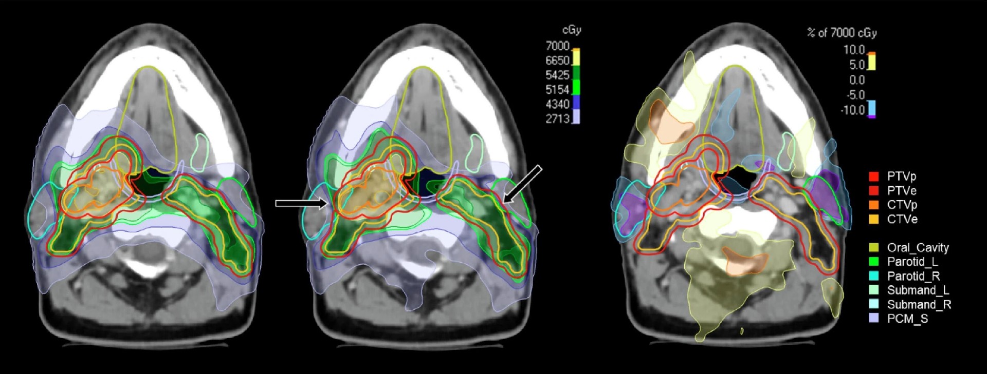 图3 典型患者常规与稳健计划的剂量分布对比
