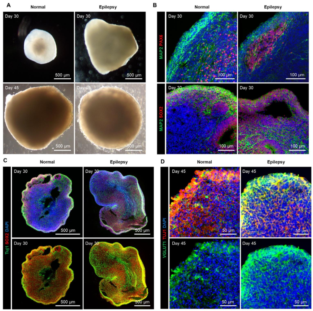 图 5：正常与 SCN2A 癫痫类器官的形态与免疫表征