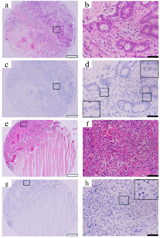 图1：结直肠癌中 INHBB 表达的 RNA 原位杂交与 HE 染色特征