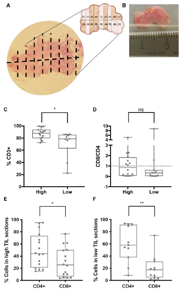 图.1 IHC 浸润程度与 TIL 亚群组成关联
